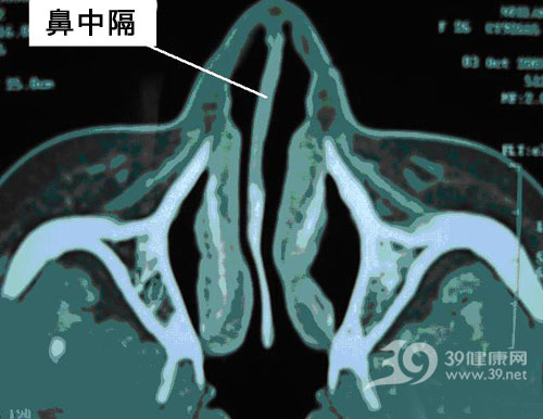 鼻窦炎竟会导致耳鸣？