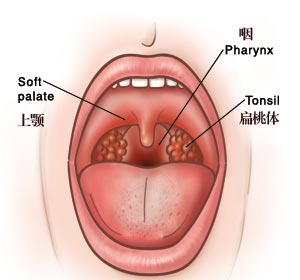 腺样体肥大和扁桃体肥大的区别在哪里？