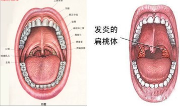 舌根扁桃体发炎怎么办？