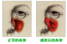 霉菌性鼻窦炎有几类？病因和治疗方法都有哪些