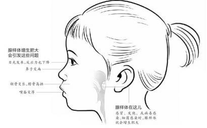 儿童腺样体肥大五大危害