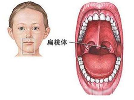 扁桃体肿大分度,治疗扁桃体炎