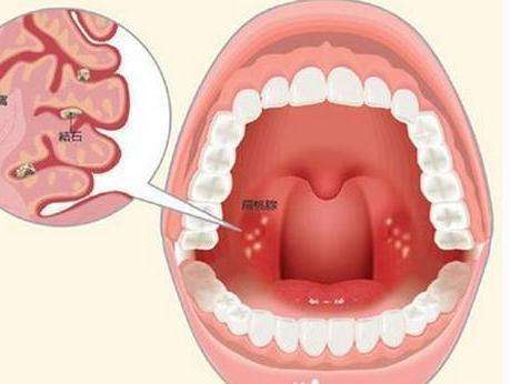 扁桃体炎和咽炎有什么区别？