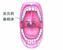 有关急性扁桃体炎的病因重要认识