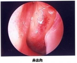 鼻息肉摘除手术是什么样的?鼻息肉的图片