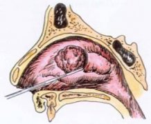 网友咨询：患有鼻甲肥大该怎么办？