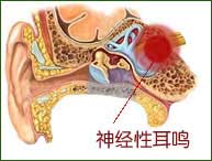 郑州民生医师解答耳鸣的症状