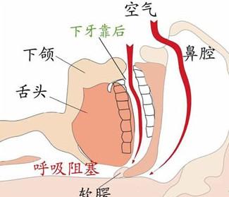 做鼾症手术多少钱