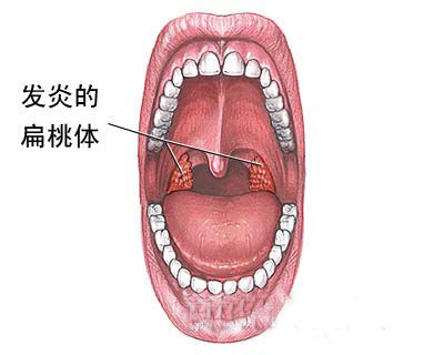 全面了解扁桃体炎 把后患消灭在萌芽状态