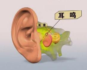 耳鸣是哪些疾病的早期信号？