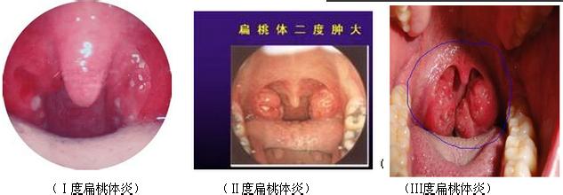 扁桃体肿大也分度？有几种情形?