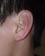 耳朵发热是怎么回事，如何治呢？