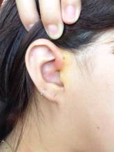 什么是耳前瘘管，需不需要治疗？