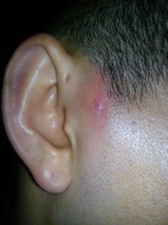 小孩耳前有个小洞是耳前瘘管吗，怎么引起的？
